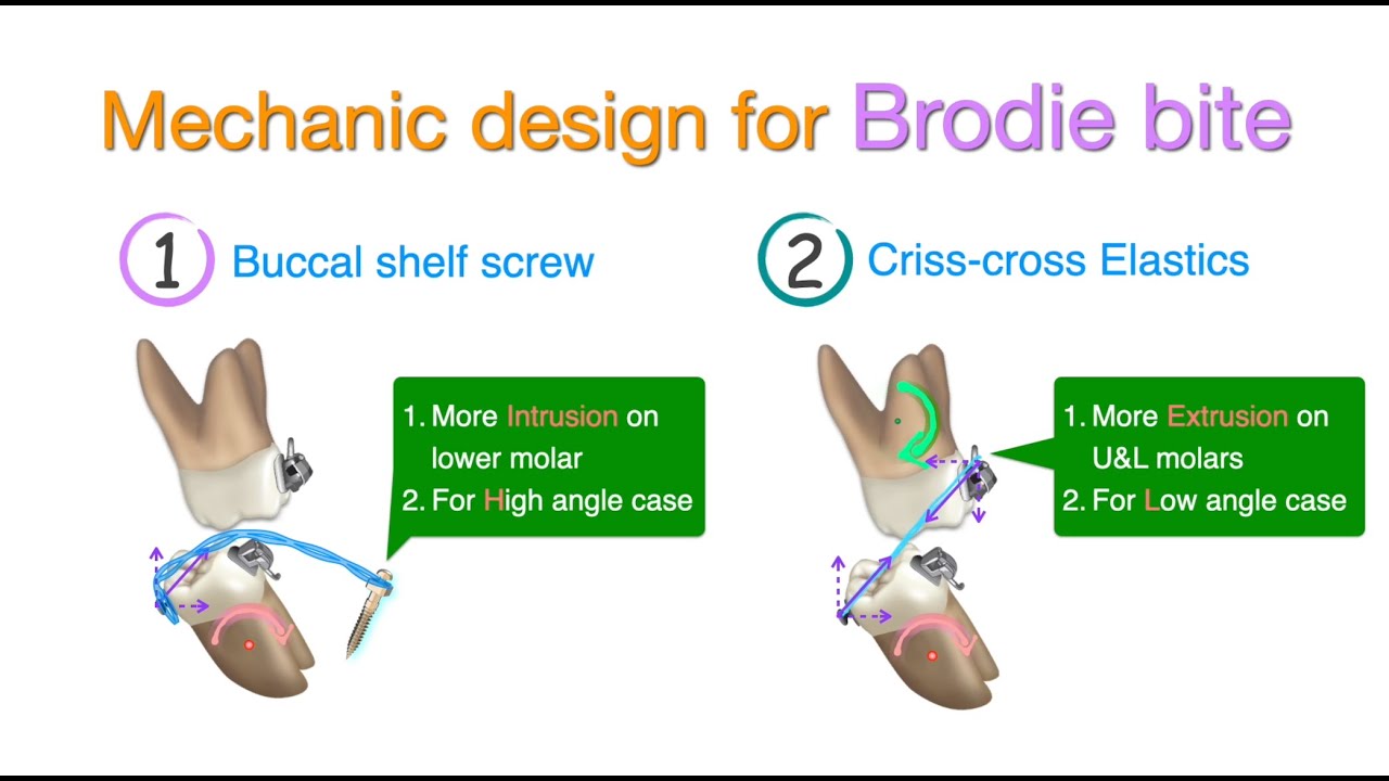 Posterior crossbite, part III |【Chris Chang Ortho】CC848