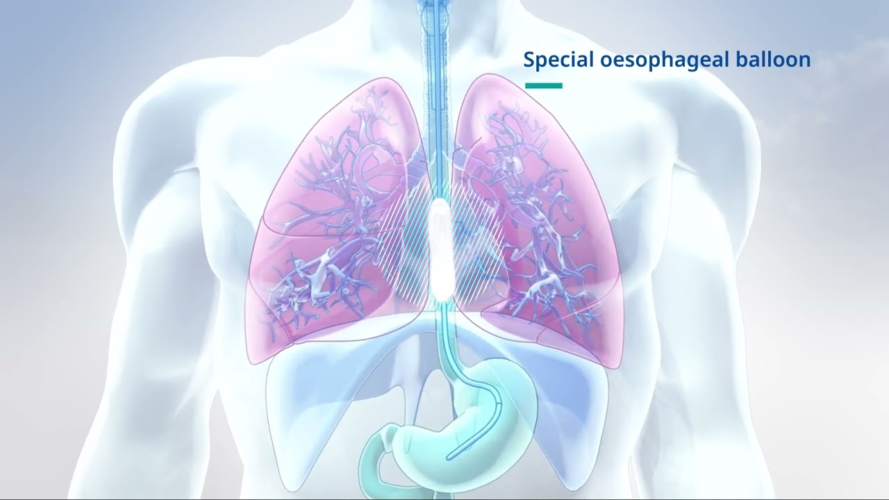PesoCath – the key for oesophageal and transpulmonary pressure monitoring