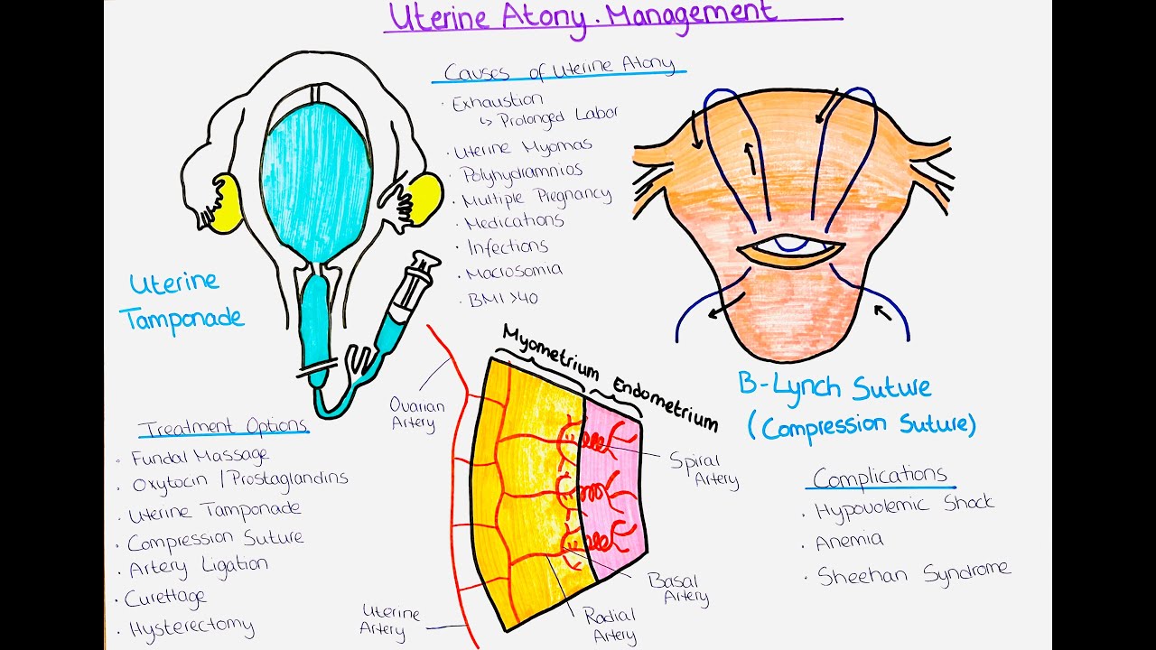 Understanding Uterine Atony and Ways to Treat it (Postpartum Haemorrhage)