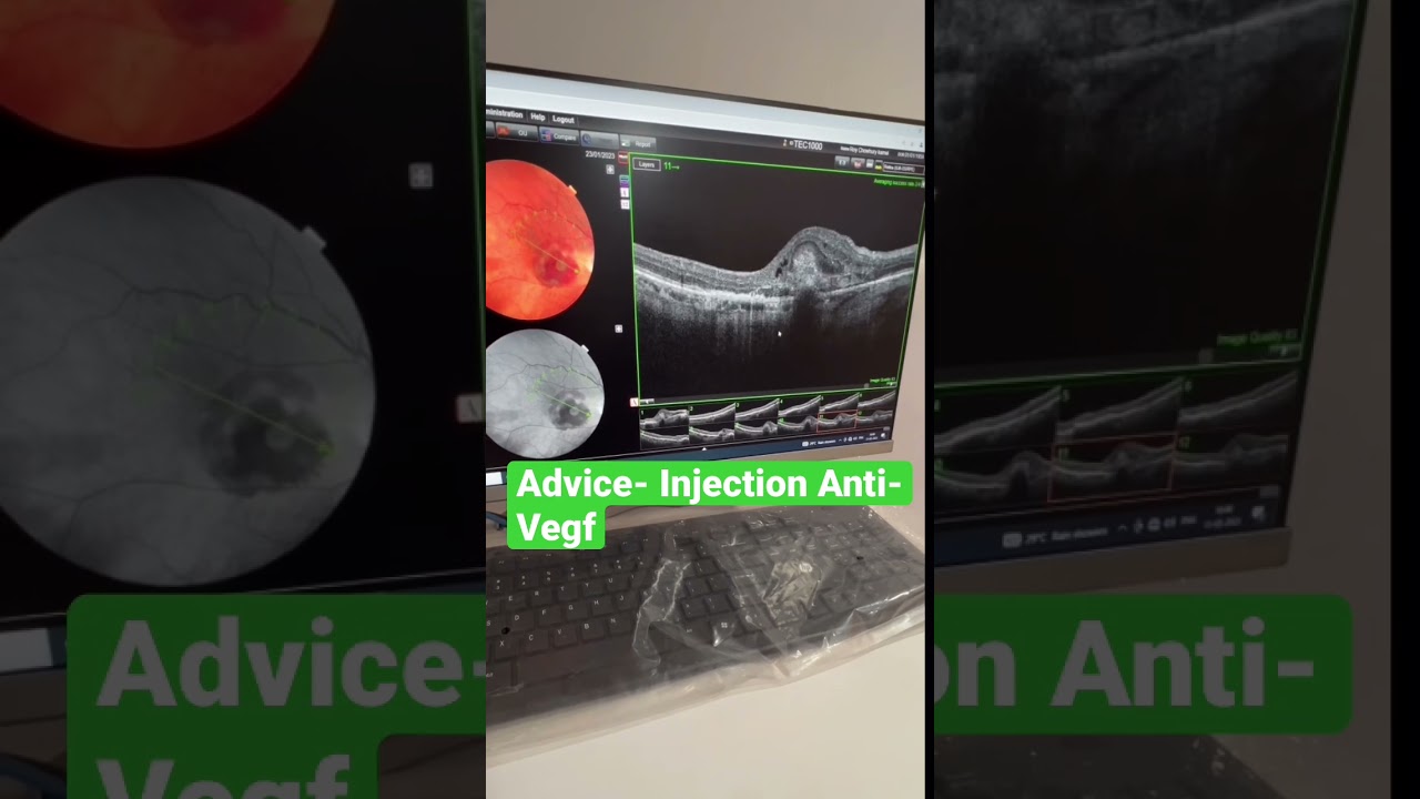 #youtubeshorts #shorts| Eye Injection| Age related eye disease| Blood in retina