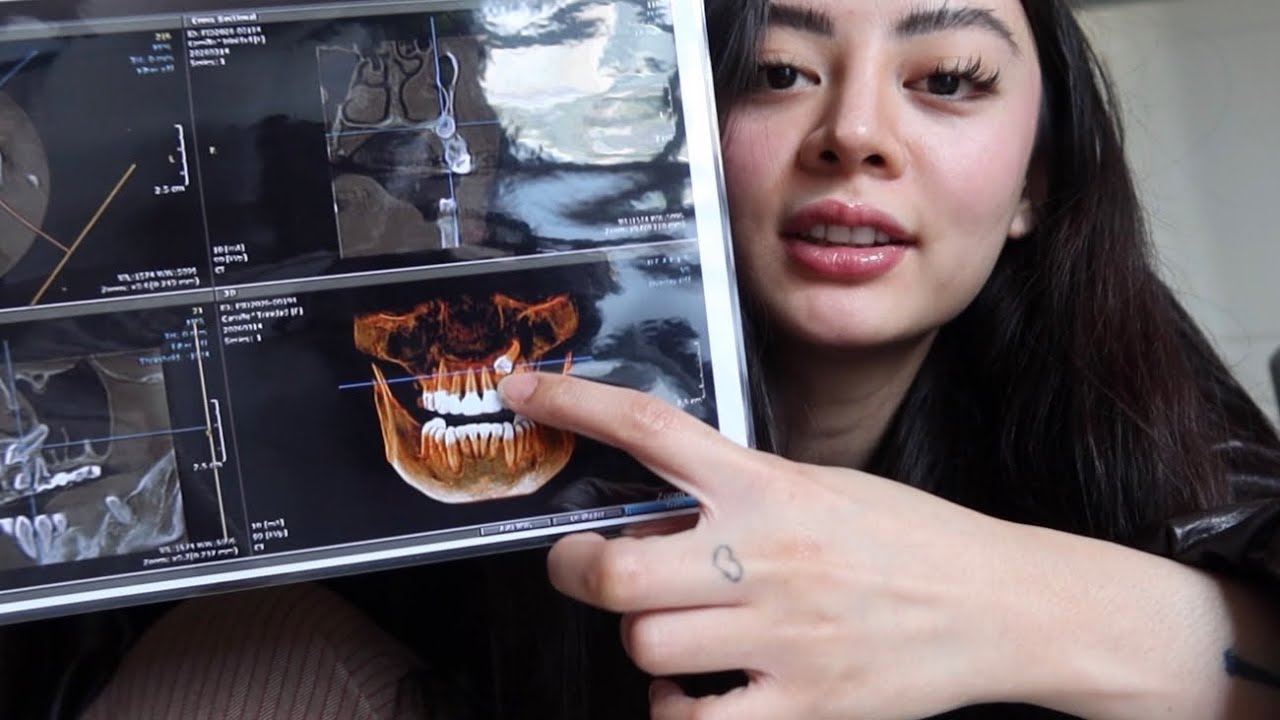 Finally Removed My Impacted Tooth (Grabe ang lala)