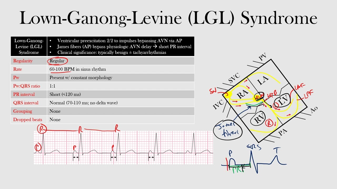 LGL Syndrome