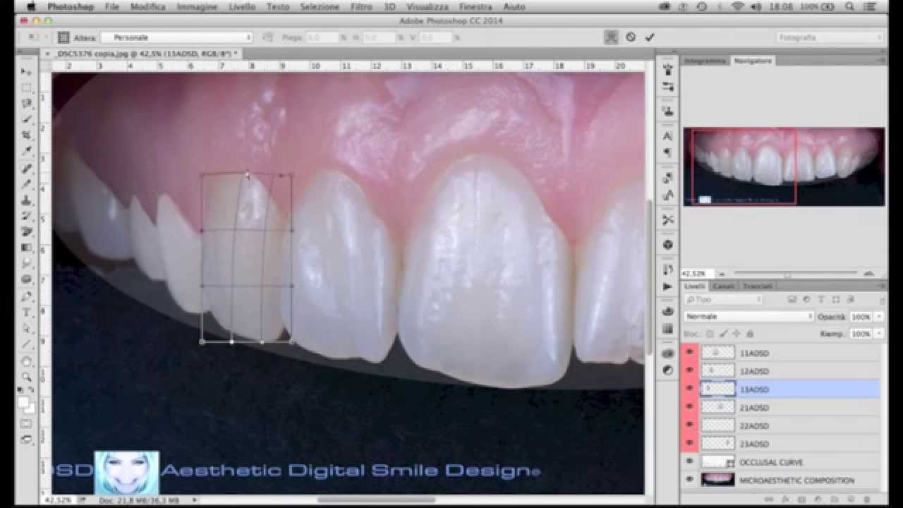 ADSD Aesthetic Digital Smile Design - DDID Digital Dental Modeling