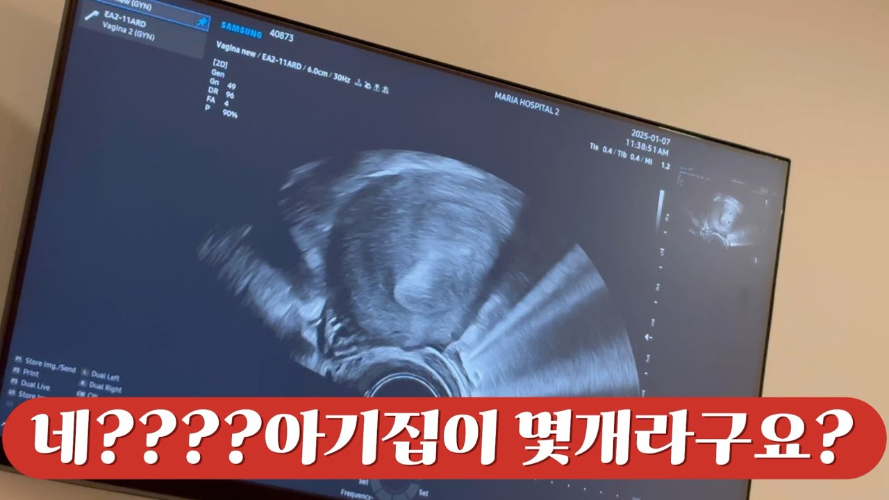 (시험관vlog)1차피검사결과ㅣ2차피검사결과 ㅣ아기집ㅣ아기집이 몇개라구요??