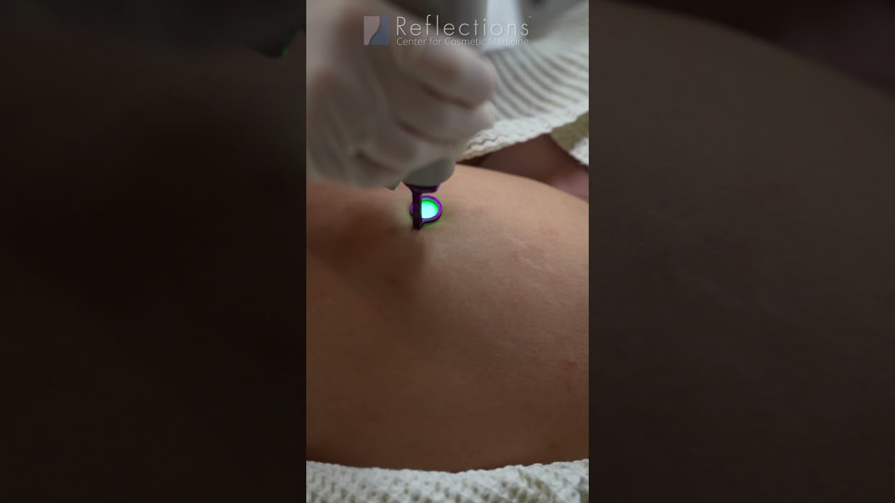 Stretch Marks Treatment