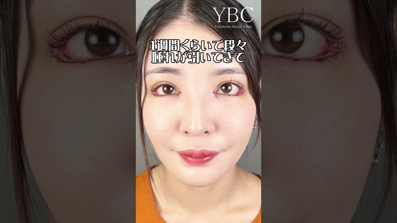 【二重整形/目頭切開/グラマラスライン形成】目元フル整形したら目が半分開かないくらいダウンタイムヤバかったけど&hellip; #shorts
