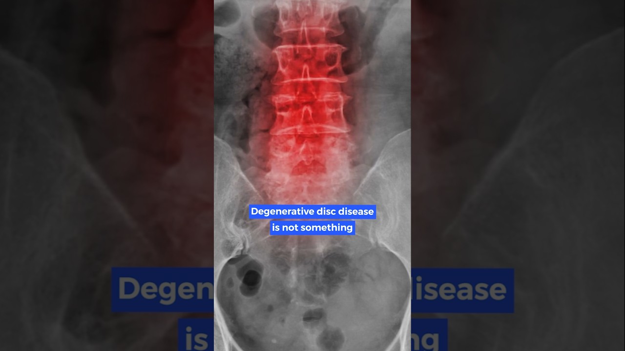 Surgery for Degenerative Disc Disease?