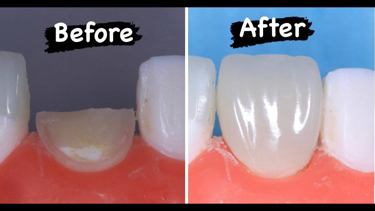 direct composite veneer step by step (with audio explanation).