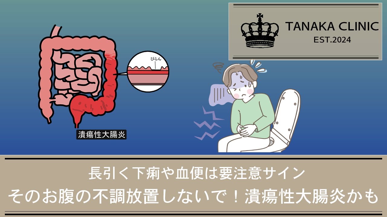 30　そのお腹の不調、放置しないで！潰瘍性大腸炎｜【胃腸と内視鏡の専門チャンネル】たなか内科クリニック
