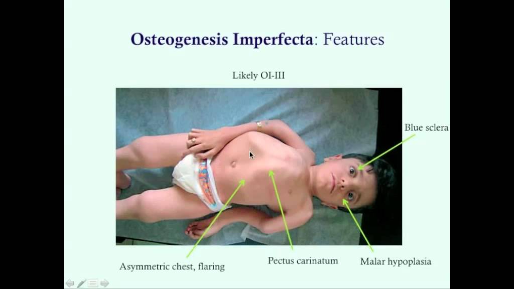Osteogenesis Imperfecta - CRASH! Medical Review Series