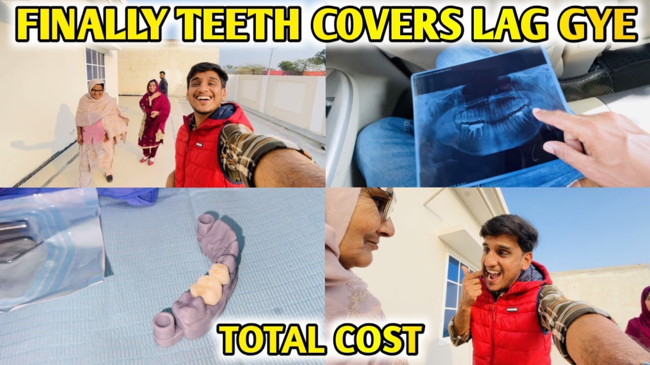 Allhumdulliah Teeth Covers Lag Gye💯 Total Cost Kitni ayi?👍Before And After Teeth Look?