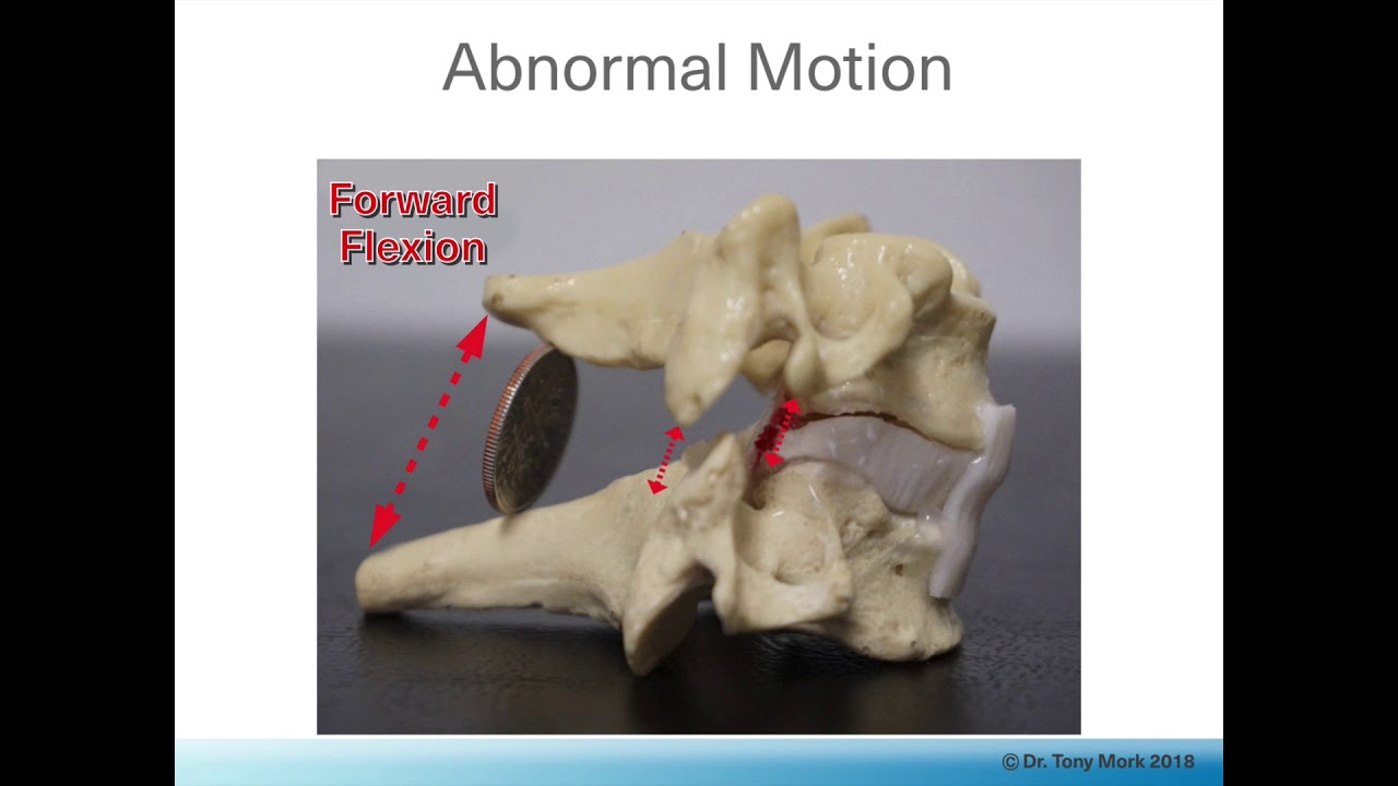 Cervical Facet Syndrome Treated with the Laser - Part 1