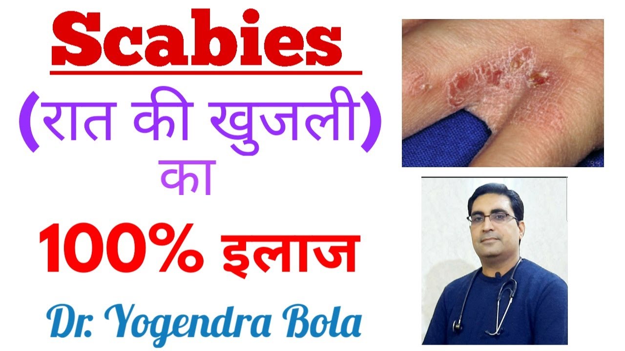 Scabies - ka  complete treatment  in hindi | scarab ,scabilice lotion, permite 5%, vermact 12 mg tab