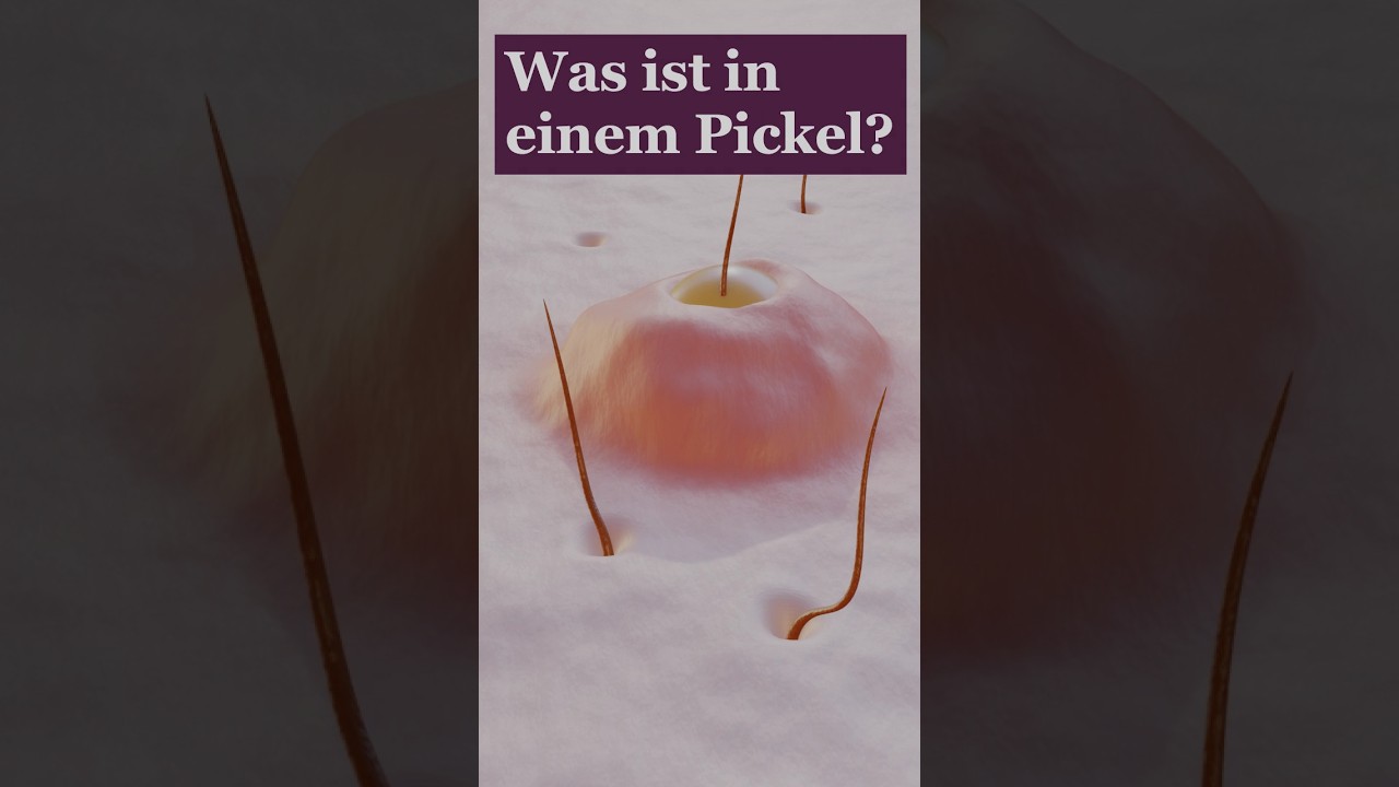 Eiter im Pickel | Aus was besteht das Sekret?