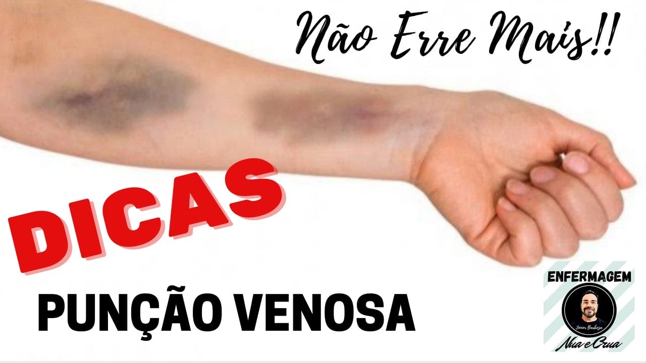DICAS Valiosas de PUNÇÃO VENOSA - Não erre mais