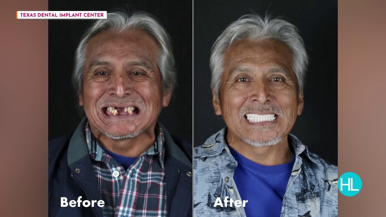 How dental implants can change your smile