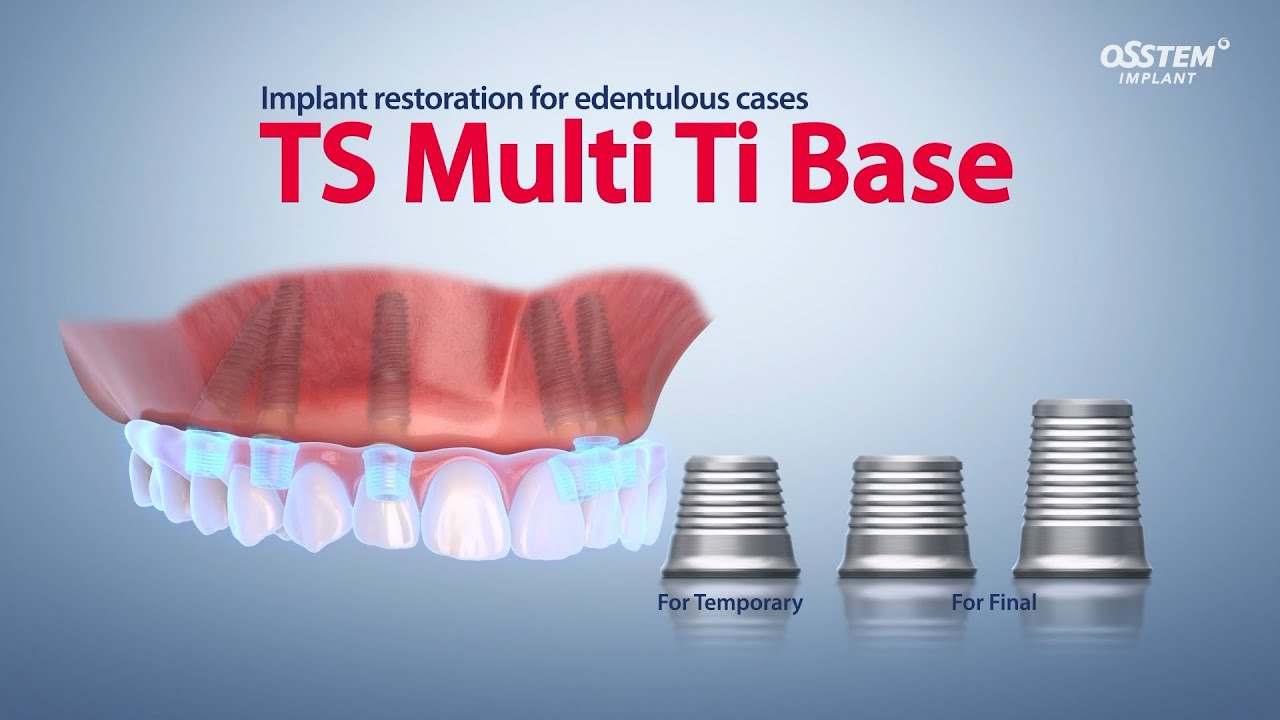 Implant restoration for edentulous cases 