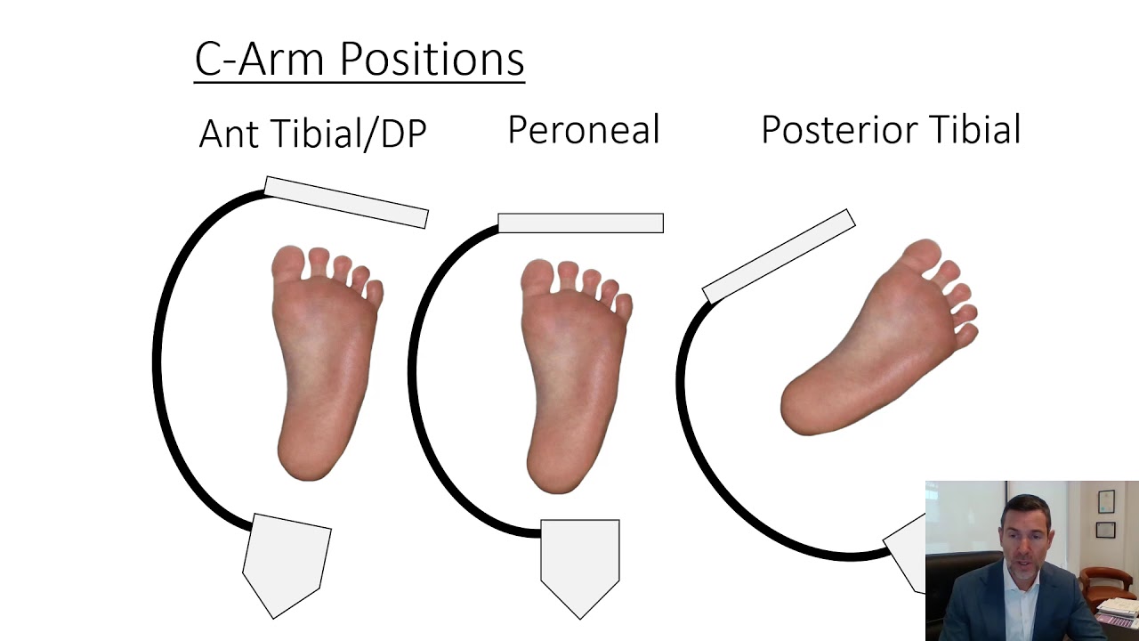 Переход FP CTO: шаг за шагом — Рамон Варко, MBBS