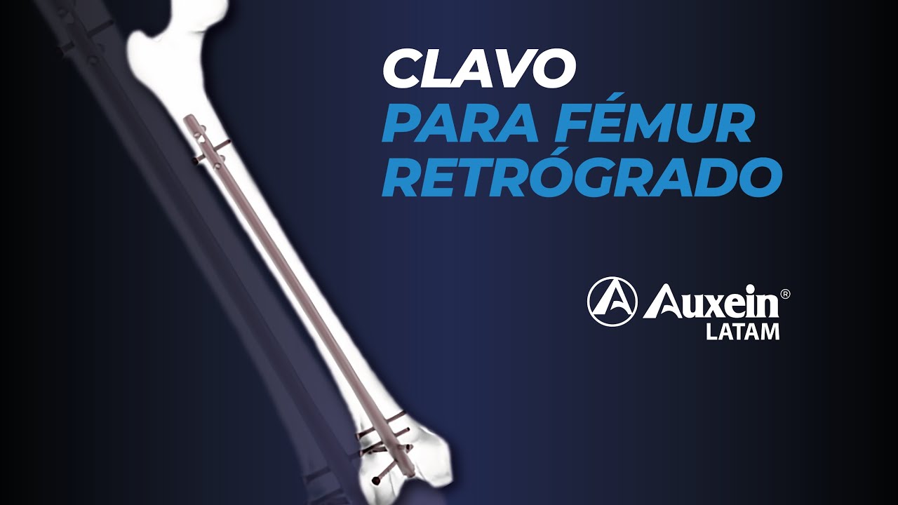 Técnica Quirúrgica de Clavo Retrogrado