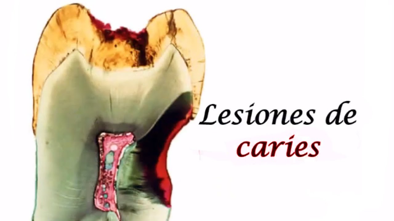 caries