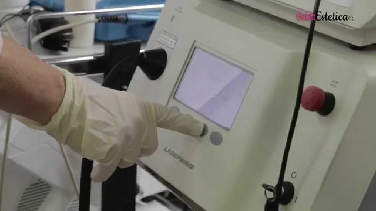 Depilazione laser a diodo col dott. Russo, dermatologo e medico estetico
