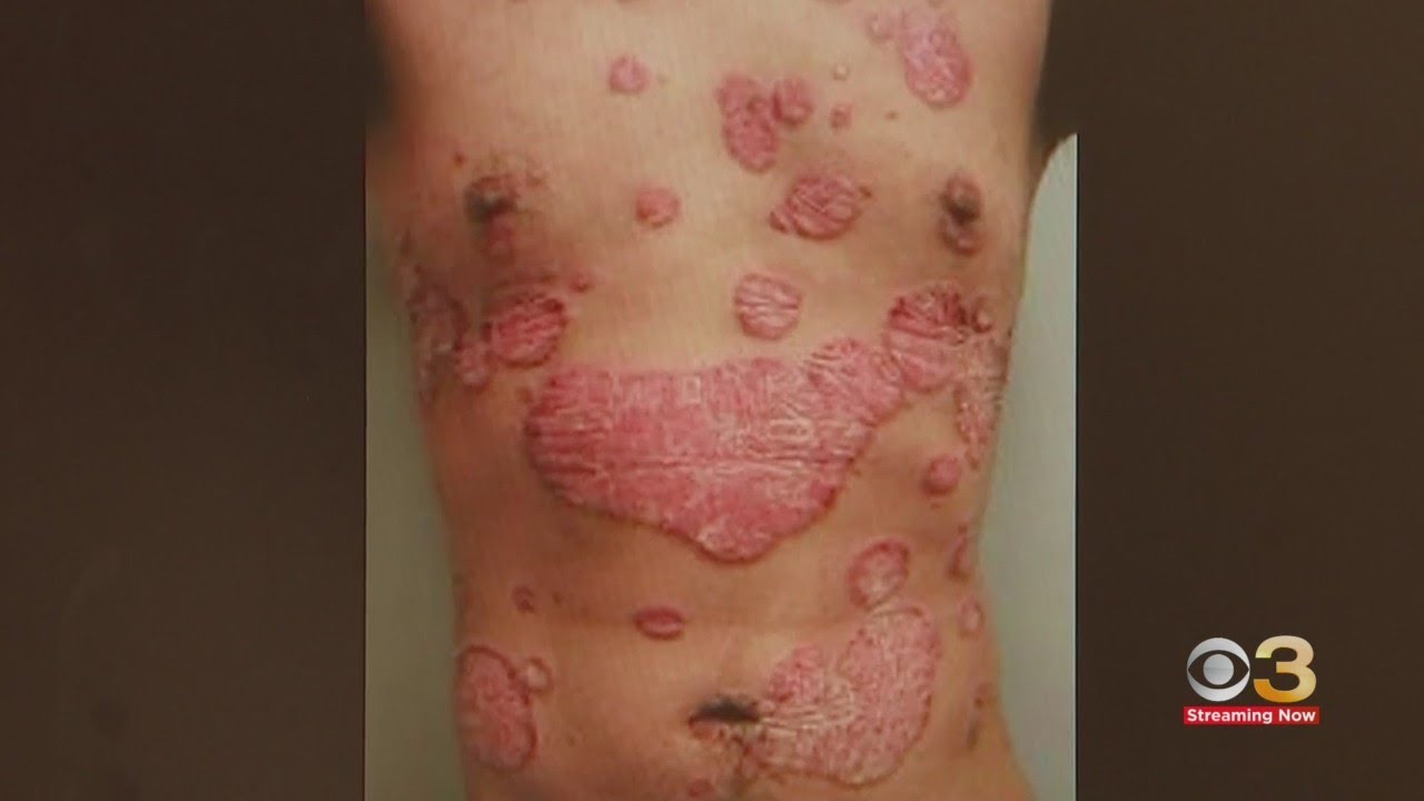 New research from UPenn says drug used to treat skin condition can also help people lose weight
