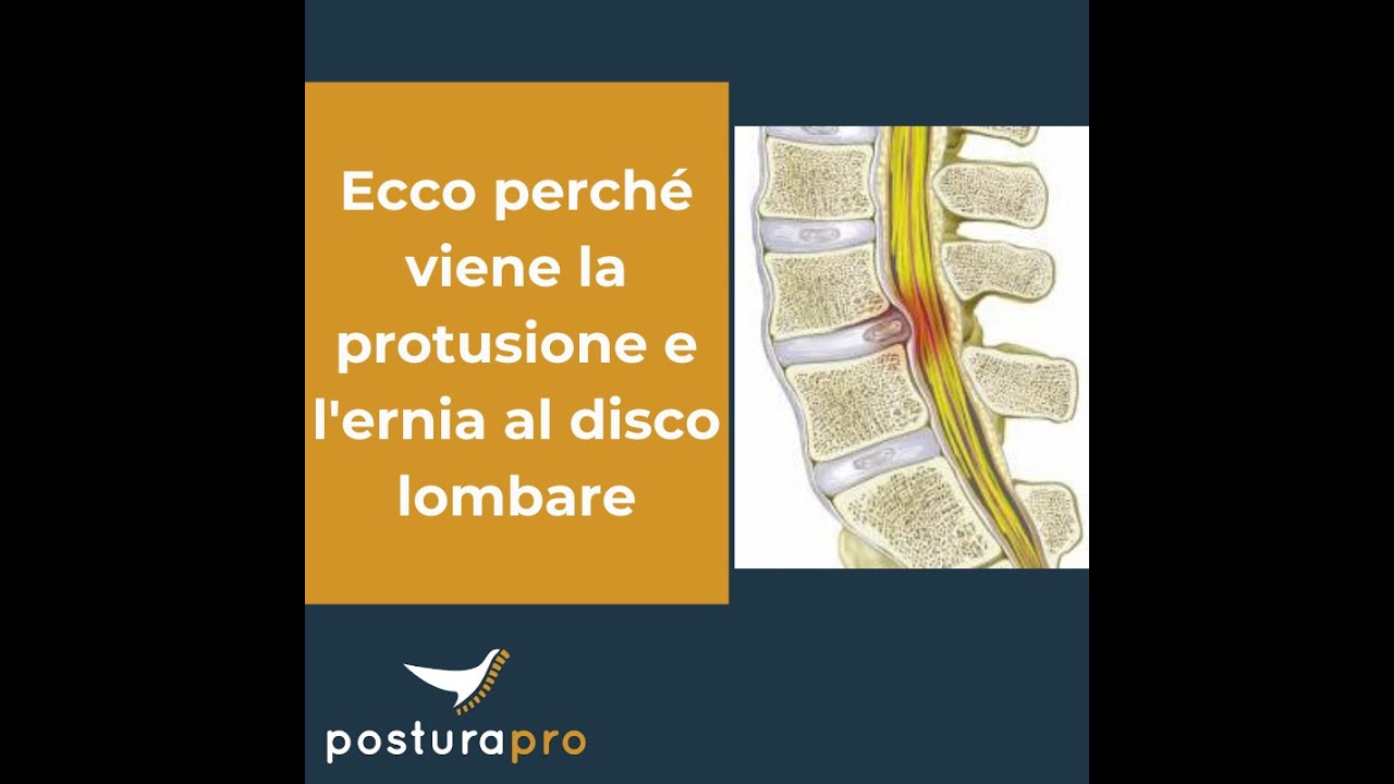 Ecco perchè viene l'ernia e la protusione al disco lombare