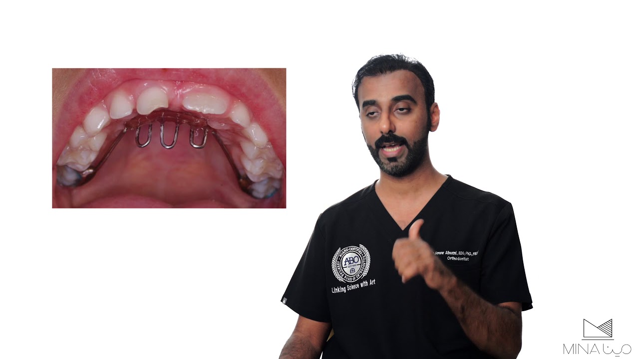 تقويم الأسنان عند الأطفال/10/بعض الأجهزة التي تستخدم لتحسين نمو الفكين للأطفال
