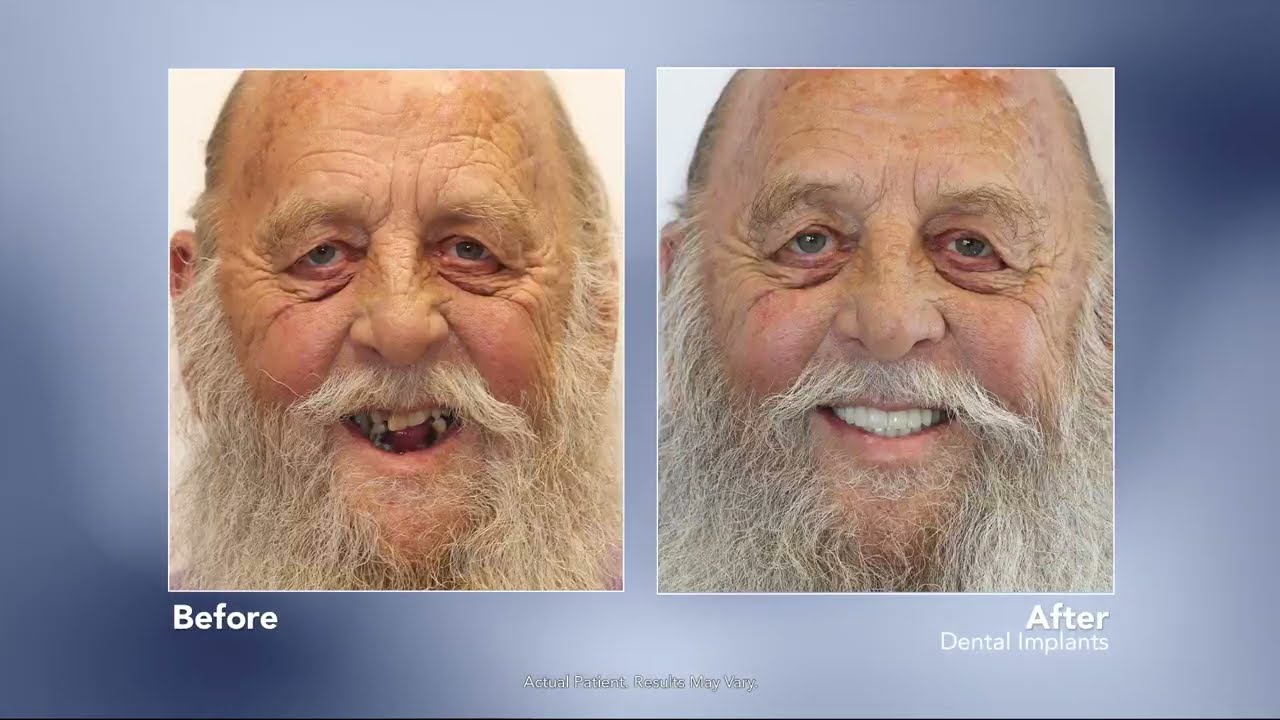 NO MORE DENTURES with Dental Implants | Art Mirelez, DDS – Fresno, CA Dentist