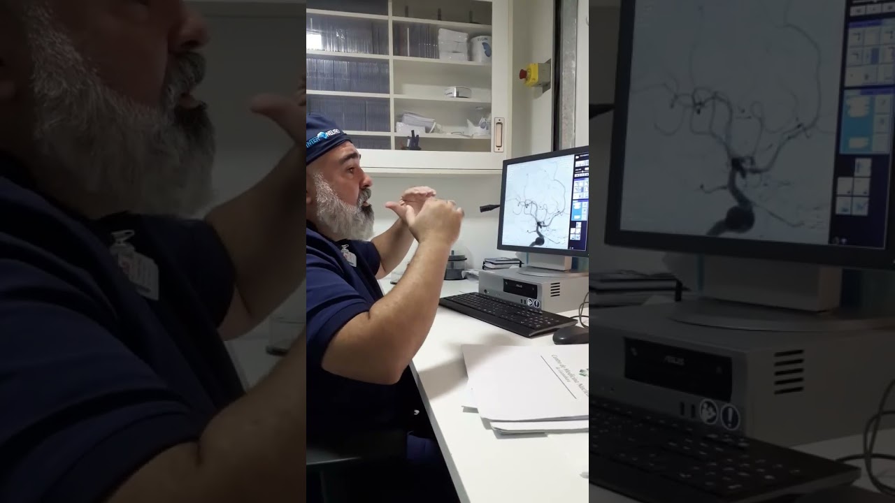 Embolização de Aneurisma Cerebral