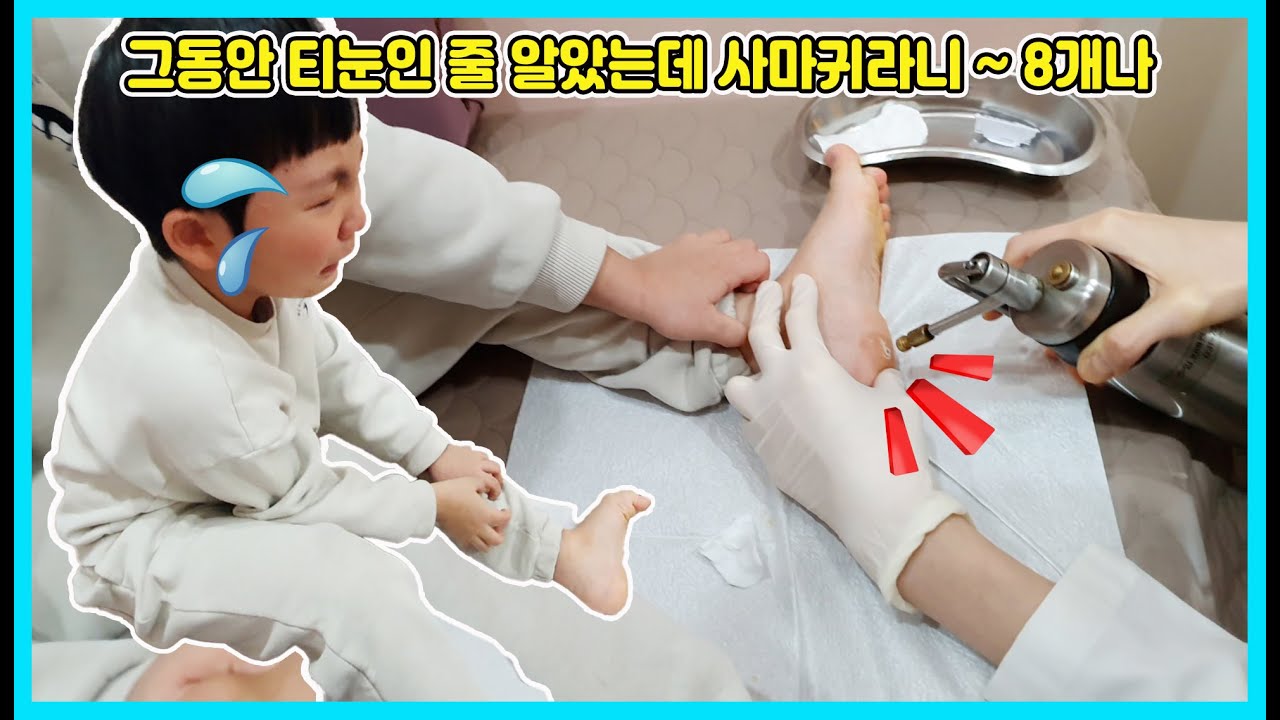 그동안 티눈인 줄 알았는데 사마귀라고 해서 놀랬어요! 바로 병원으로 가서 치료를 했어요 근데 아직도 여러번 병원에 가서 치료를 해야 해요 [사랑아놀자 LOVE&TORY]