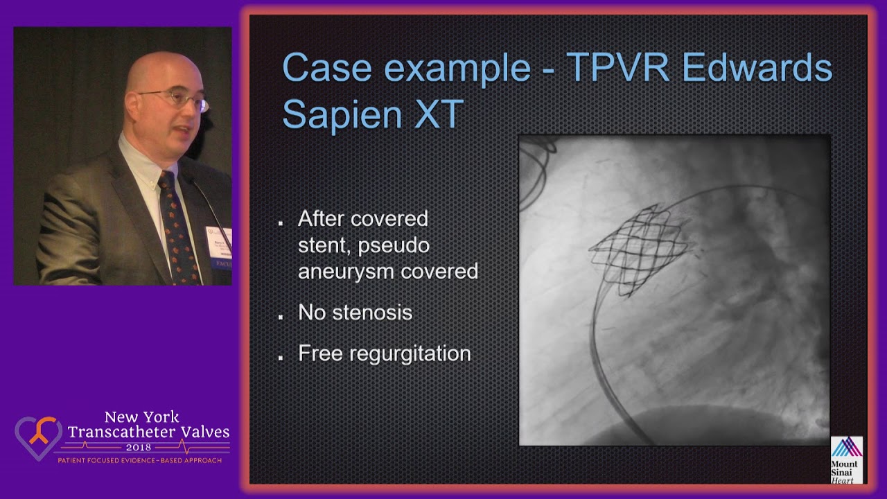 TAVR: Update on the Progress and Outcomes - Dr. Barry Love