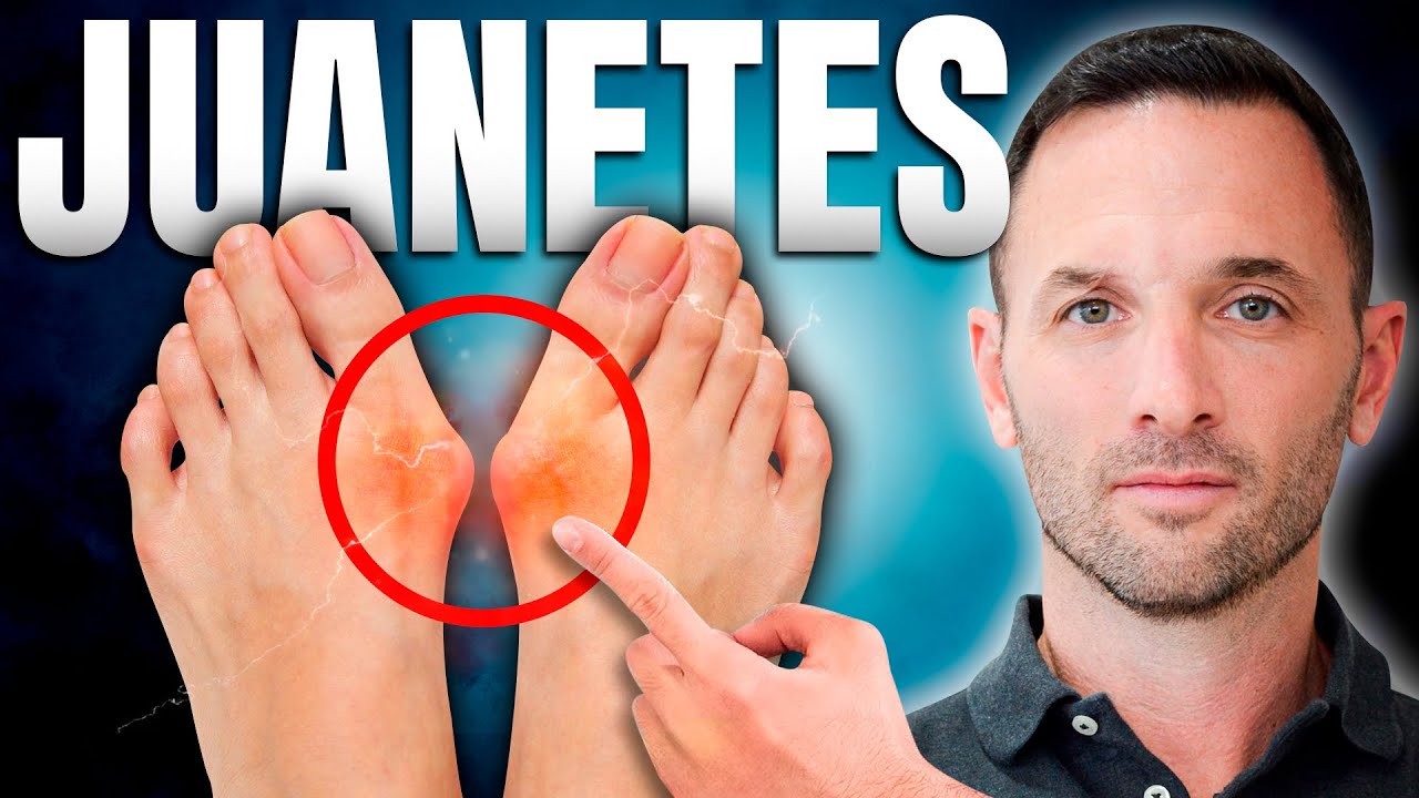 ELIMINA los JUANETES de tus pies con estos consejos CLAVE