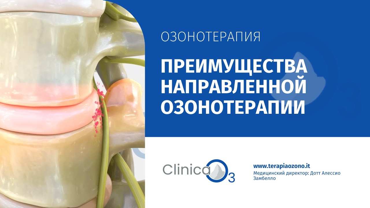 Преимущества направленной озонотерапии для лечения грыж и протрузий