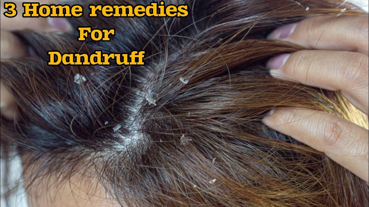 Home Treatments for Dandruff | How to Treat Dandruff at Home #skincare#haircare