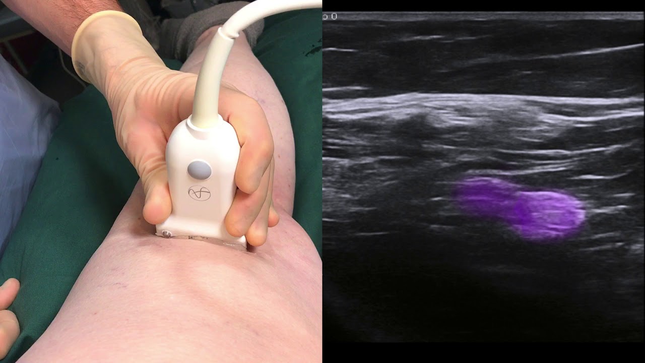 Ultrasound guided popliteal sciatic nerve block