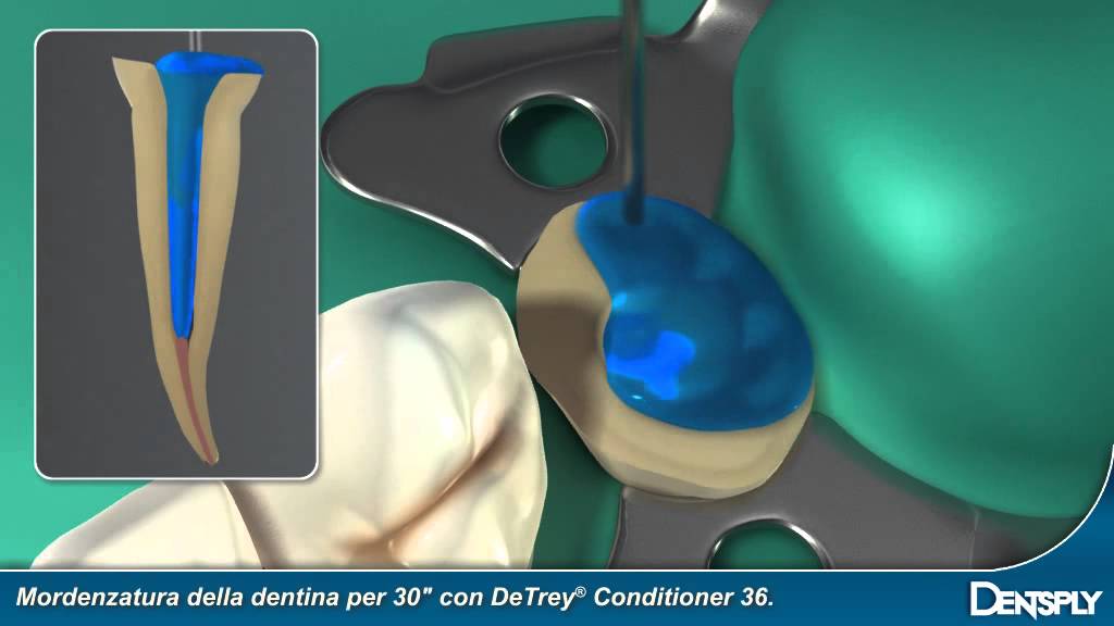 Dentsply Core&Post System