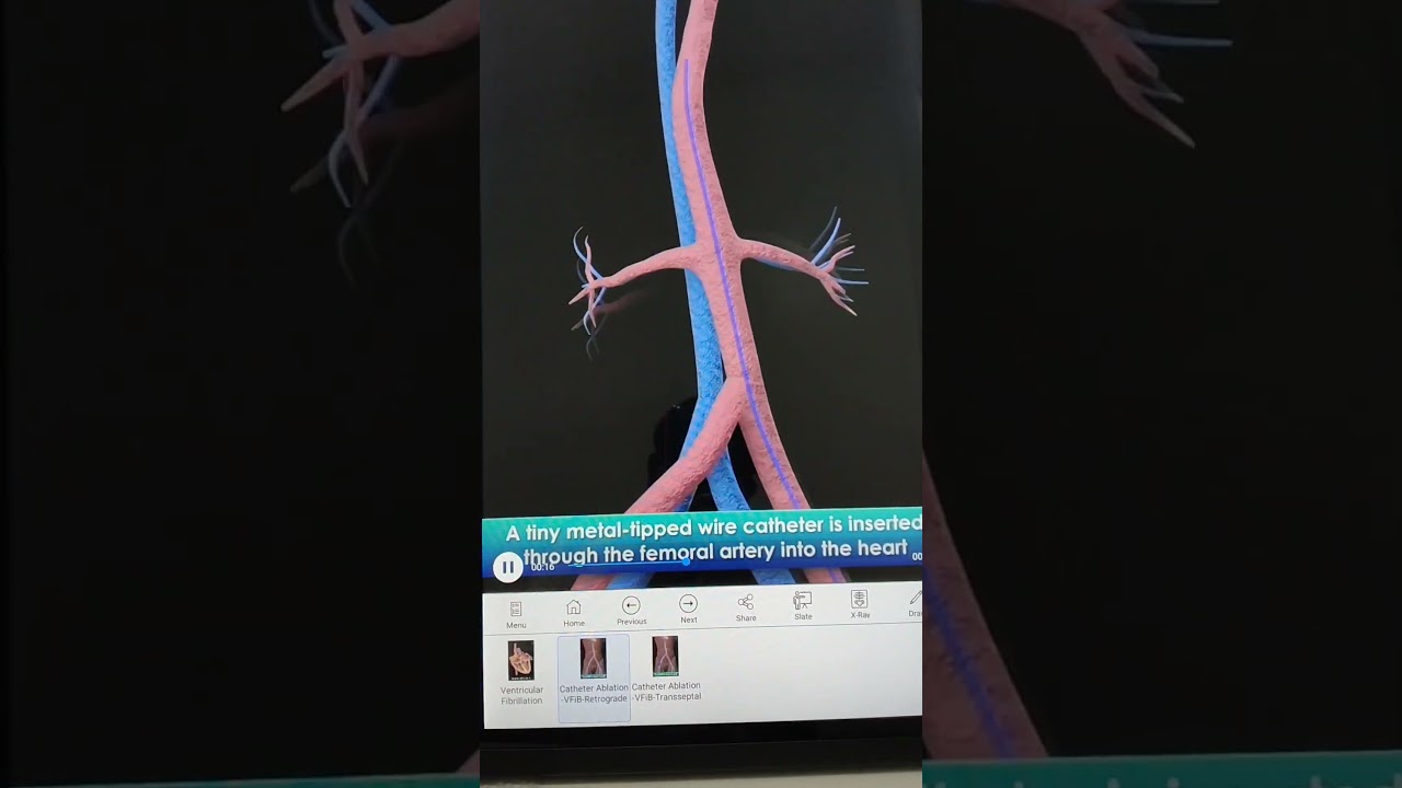 #catheter ablation#atrial fibrillation#ablation#VF#heart#ai#anatomy#AV node#ai