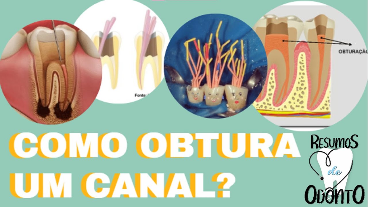 COMO É A OBTURAÇÃO DO CANAL ENDODÔNTICO