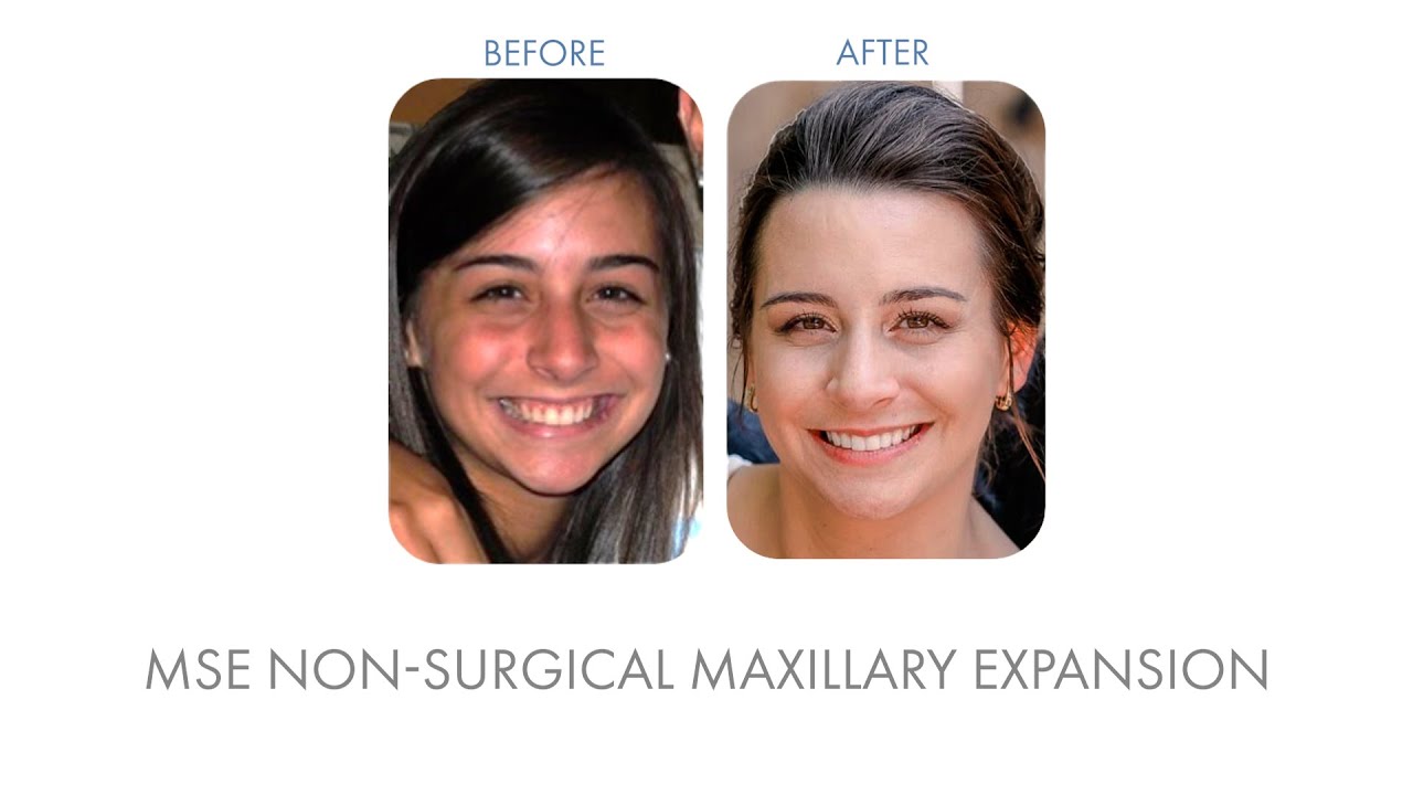 Alyssa (patient/team member) - MSE Non-Surgical Maxillary Expansion