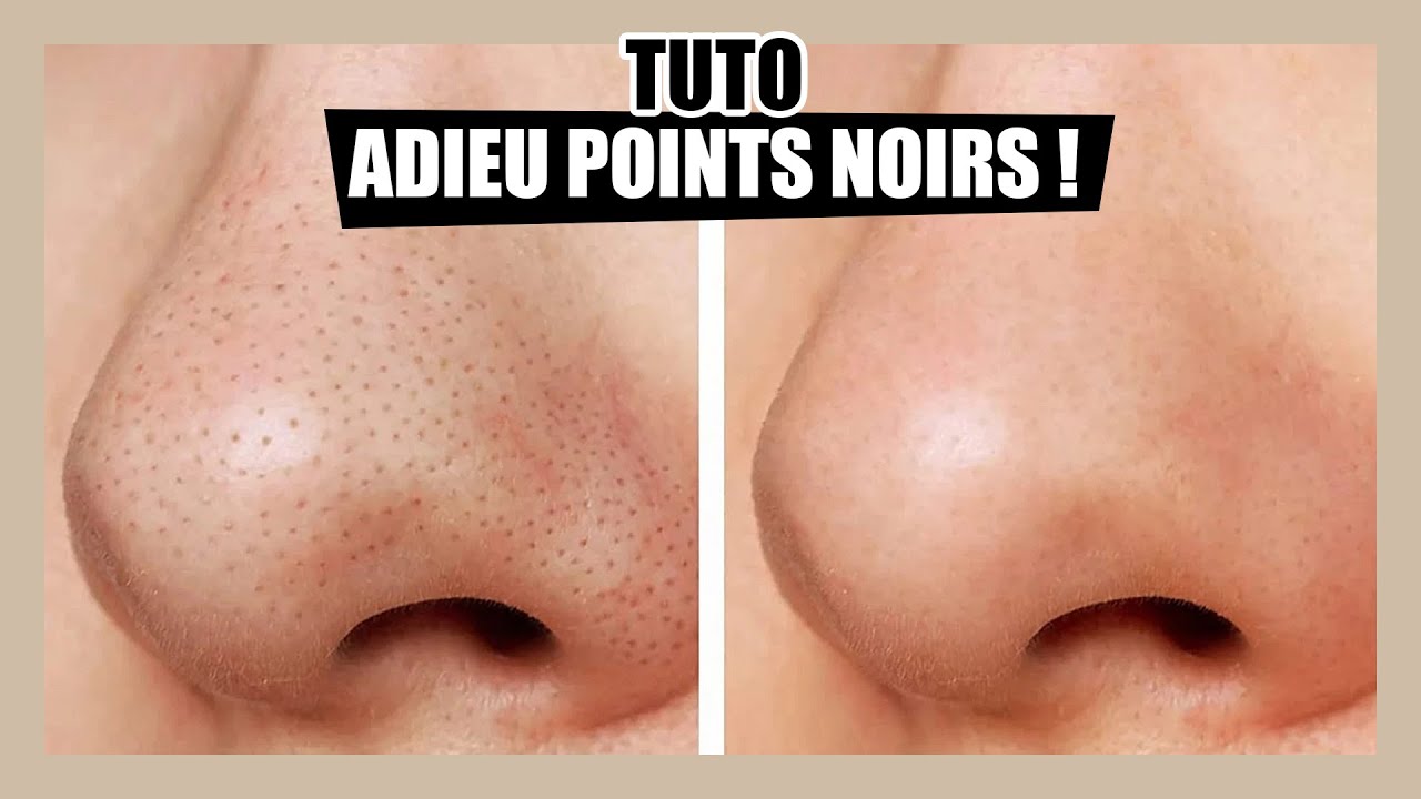 TUTO : Comment se débarrasser des points noirs facilement !