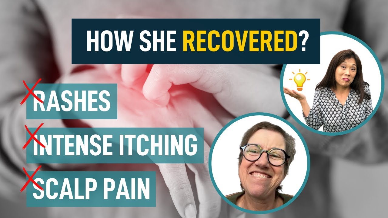 Amyopathic Dermatomyositis - Recovery From Rashes, Intense Itching, Scalp Pain. Maggie Yu, MD