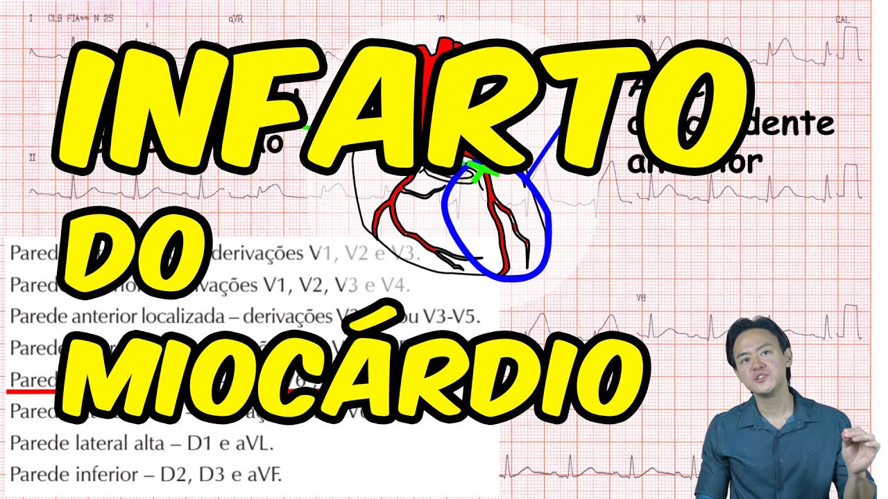 Infarto do miocárdio - avaliando o ECG