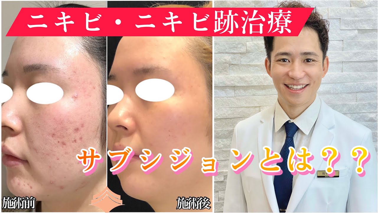 サブシジョン？？