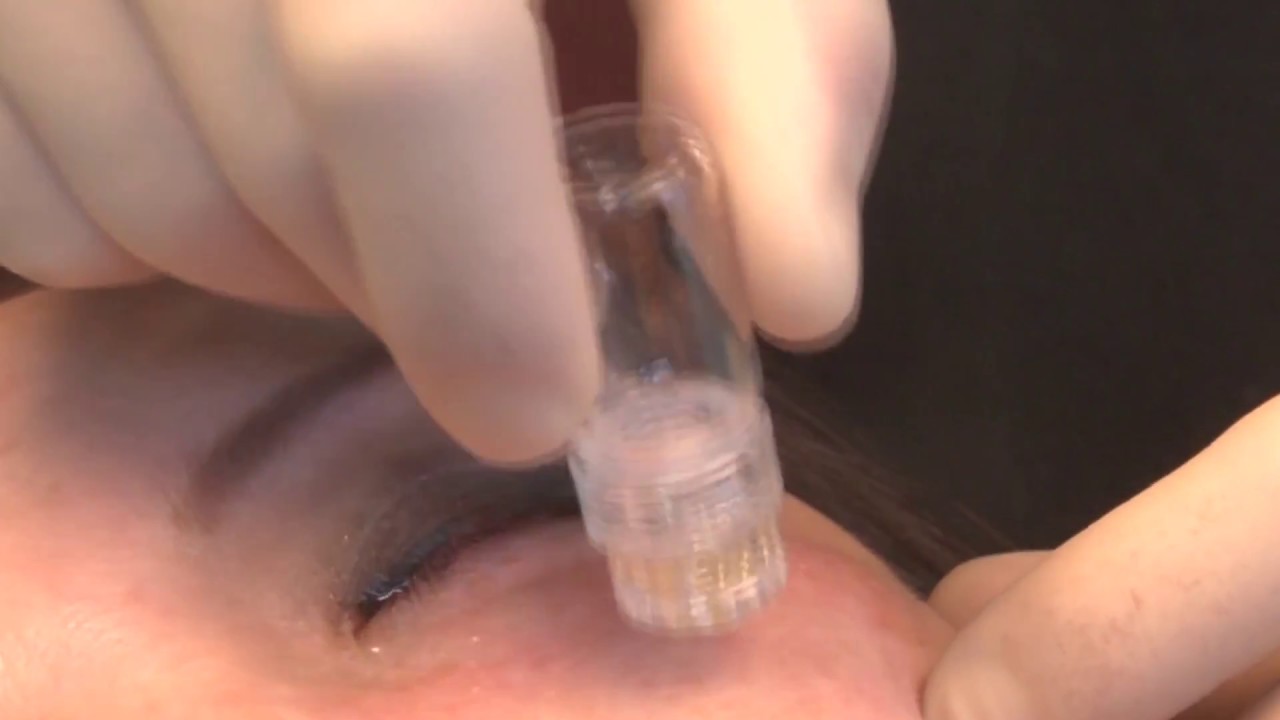 Dr. David Shafer iMicrotox Treatment