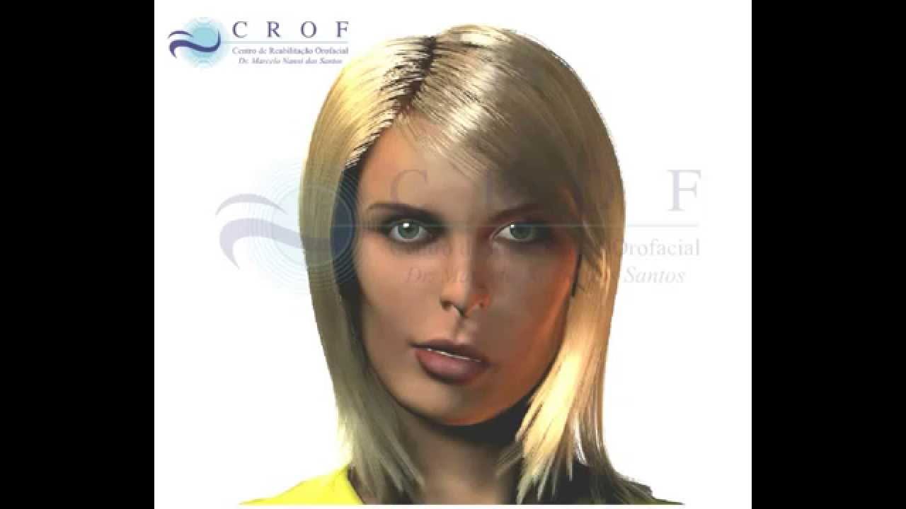 CIRURGIA ORTOGNÁTICA - ASSIMETRIA FACIAL - Dr. Marcelo Nanni