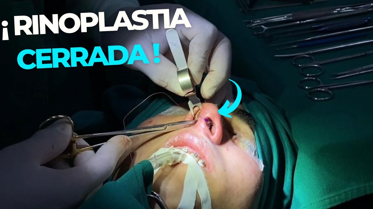 RINOPLASTIA CERRADA II Dr. Santiago Pesántez