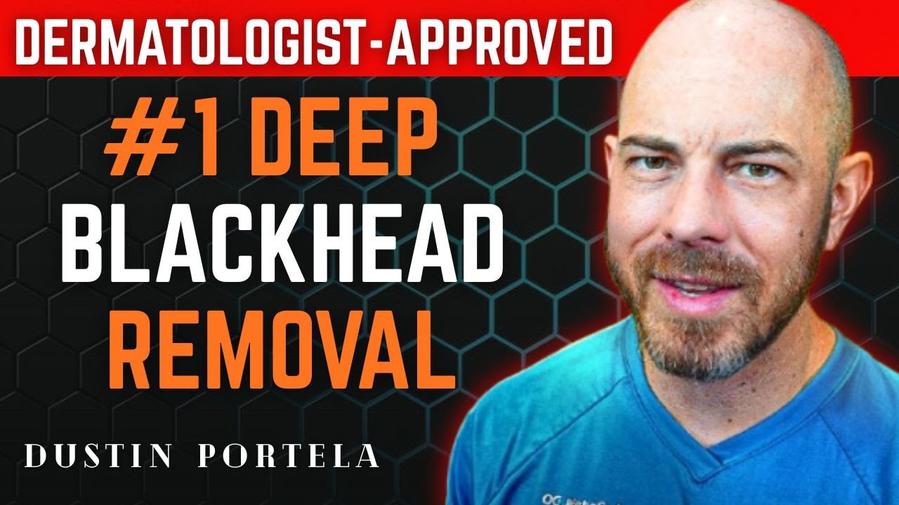 The #1 Dermatologist-Approved Method for Deep Blackhead Removal at Home&rdquo; | Dustin Portela