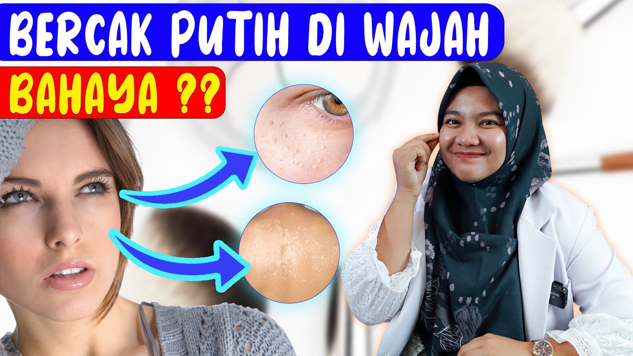 PENYEBAB BERCAK PUTIH PADA WAJAH- DOKTER WSP