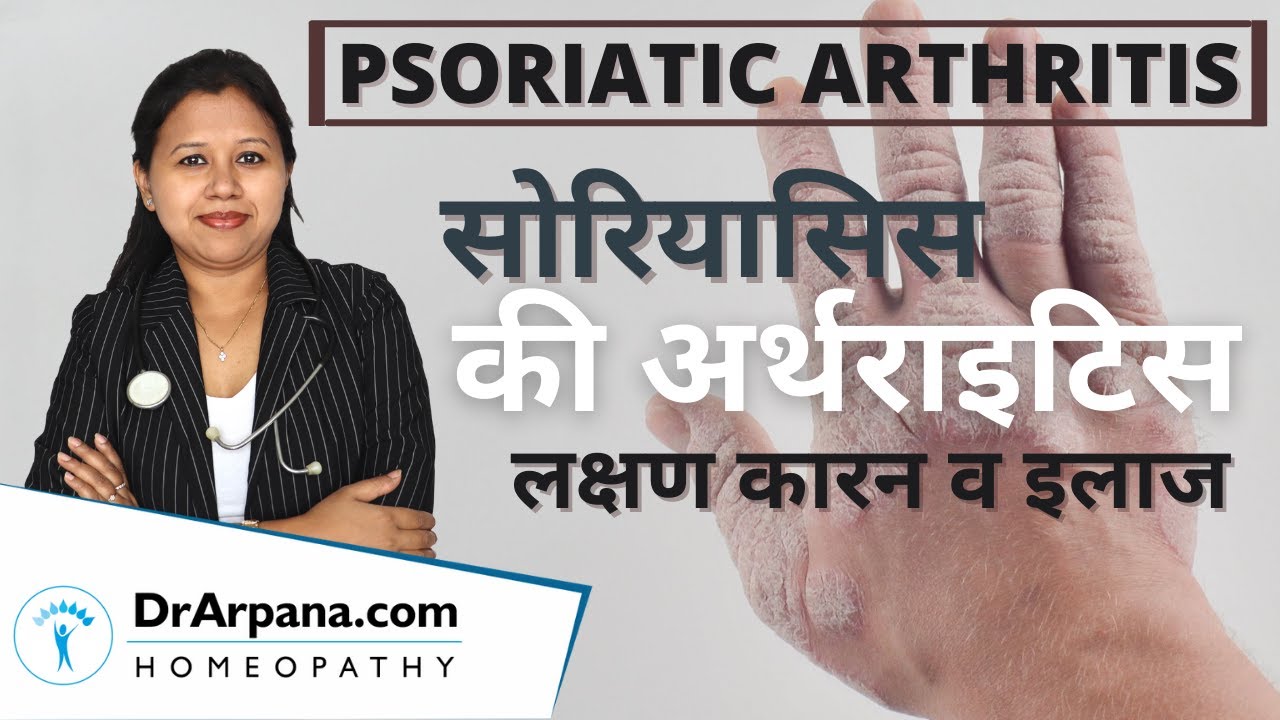 PSORIATIC ARTHRITIS सोरियासिस चर्म रोग के साथ आर्थराइटिस